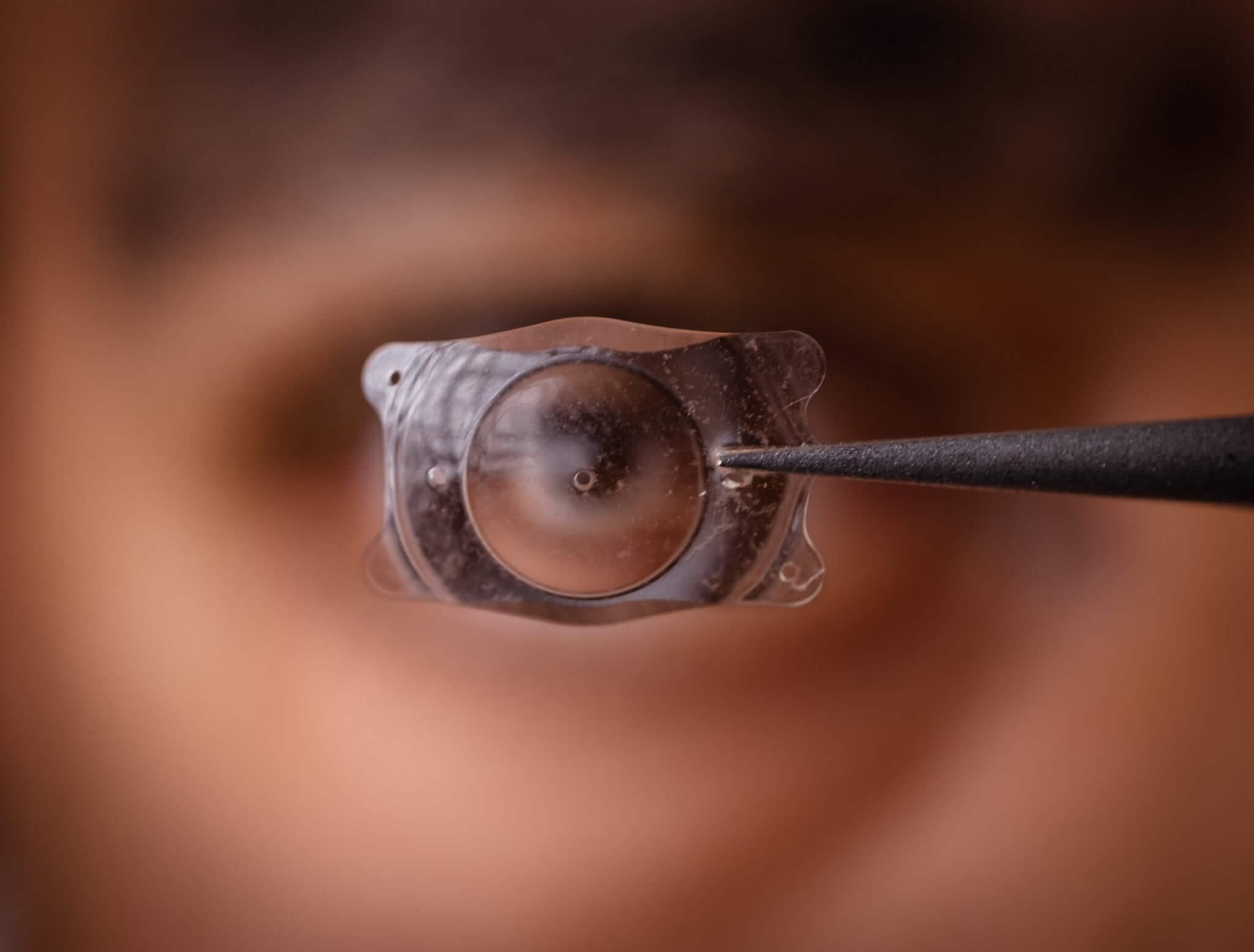 Nahaufnahme einer Implantatlinse vor einem unscharfen Auge, gehalten von einer Pinzette.