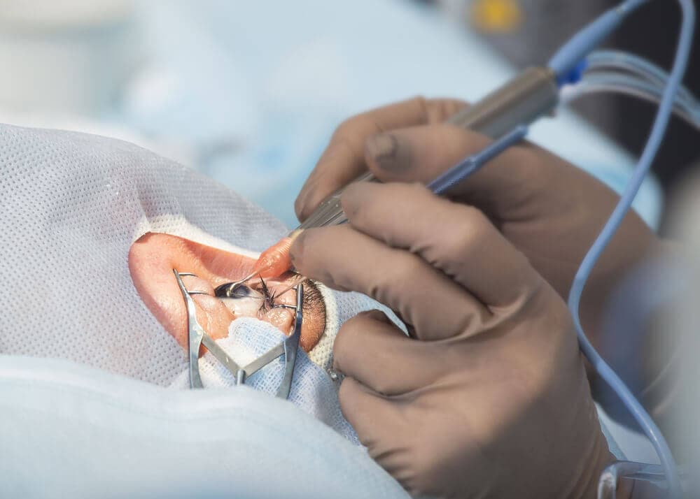 Chirurgische Augenoperation mit präzisen Instrumenten und sterilem Tuch.