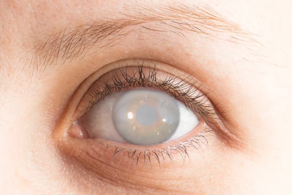 Eye,With,Cataract,And,Corneal,Opacification