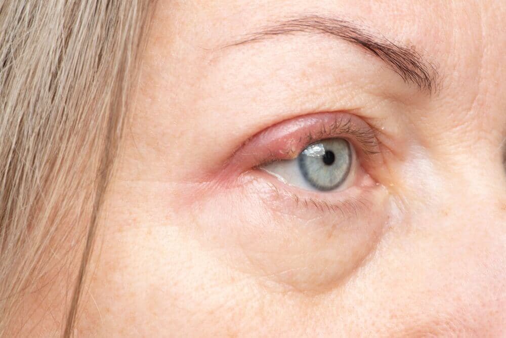 Nahaufnahme eines blauen Auges mit geröteter, geschwollener Augenpartie, Fokus auf Lidrand.
