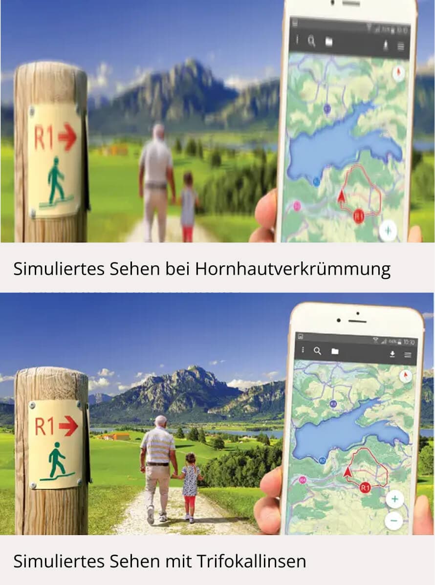 Hornhautverkrümmung-sicht